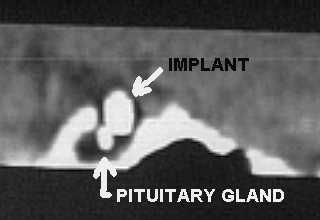 Close up of implant